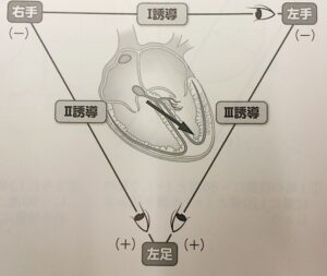 einthoven's triangle